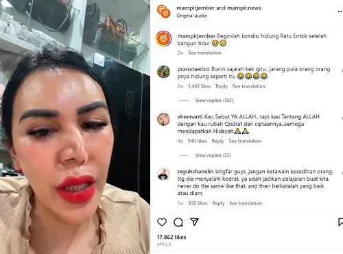 Bentuk Hidung Wanita Ini Berubah Setelah Bangun Tidur